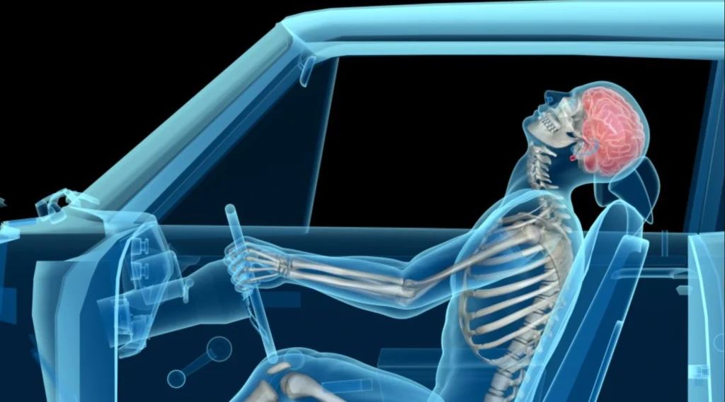 details of whiplash after a car accident